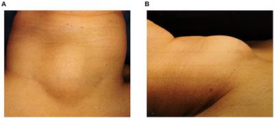 Primary synovial sarcoma of the thyroid gland: a CARE compliant case report and literature review